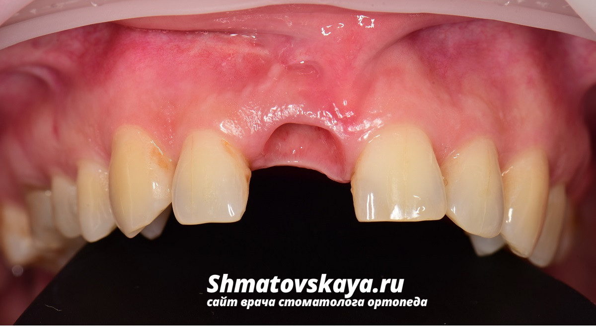 имплантат область 11 зуба